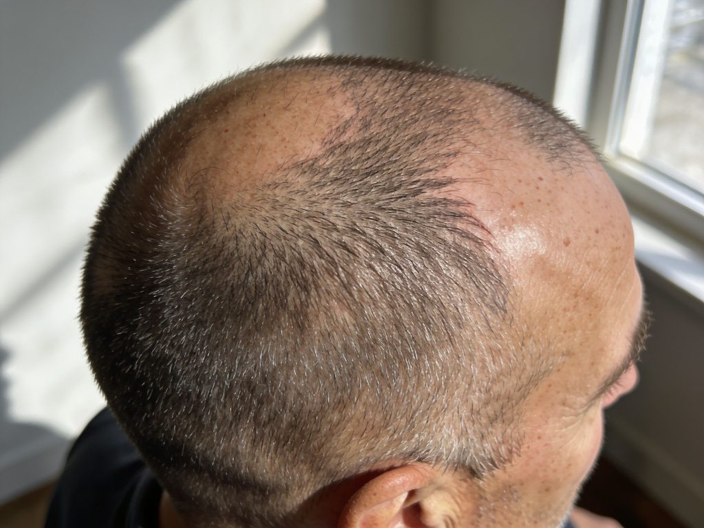 scalp micropigmentation near me united states