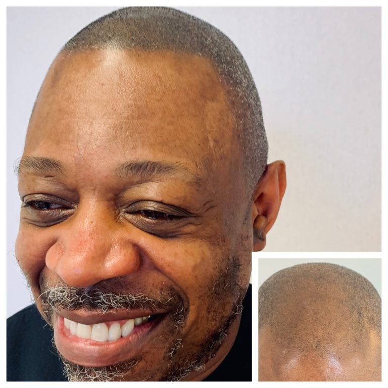 Male scalp with closely-shaved hair and SMP treatment creating natural-looking follicle density across the head.