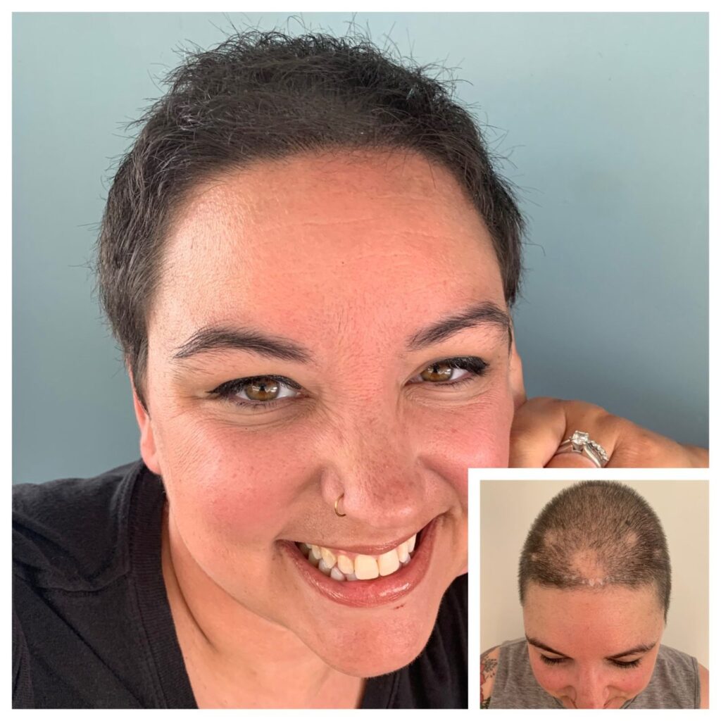 Smiling woman with short dark hair, with an inset photo of her buzzed scalp showing a pale scar line at the hairline.