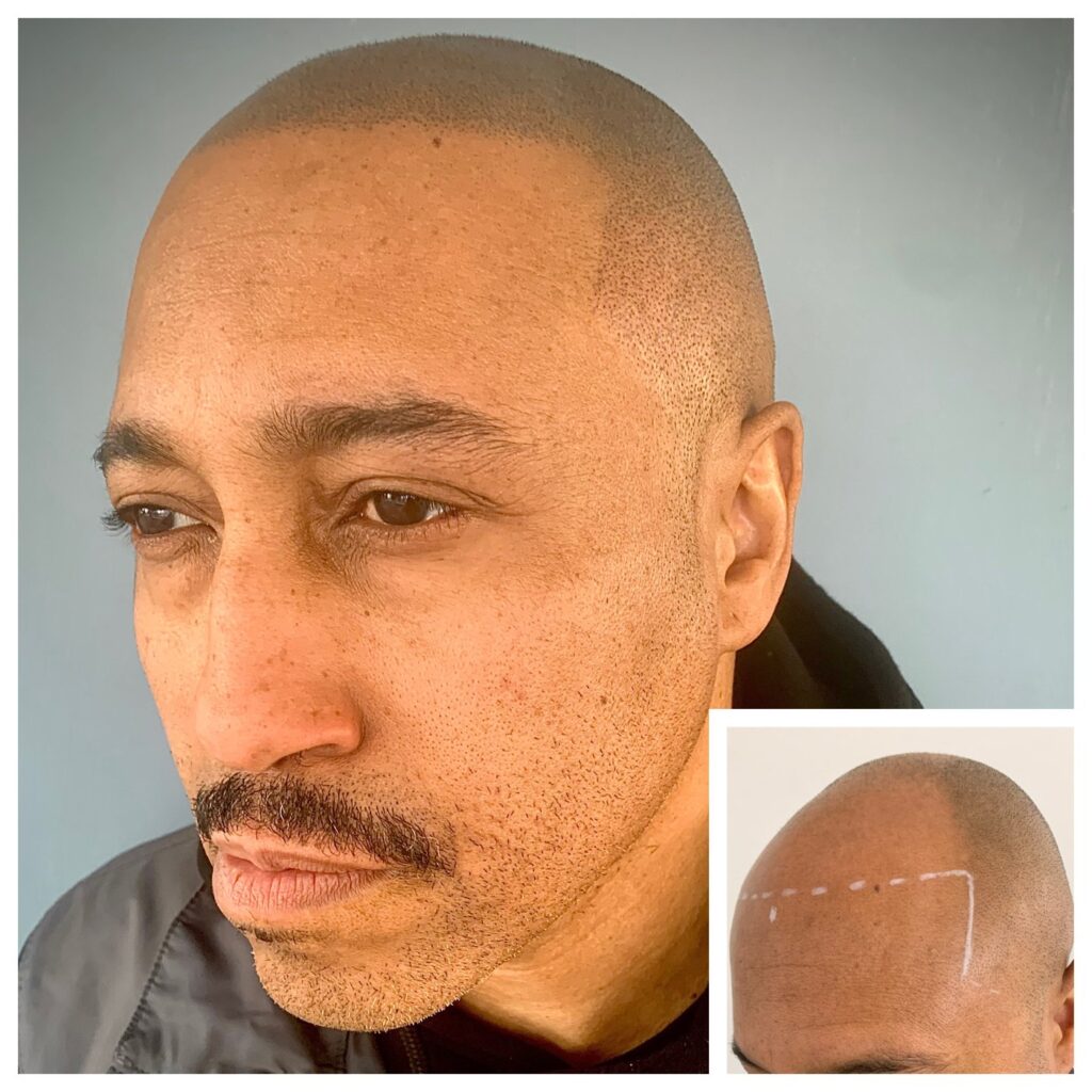 Close side view of a man with a shaved head showing fine, even pigment dots at the hairline