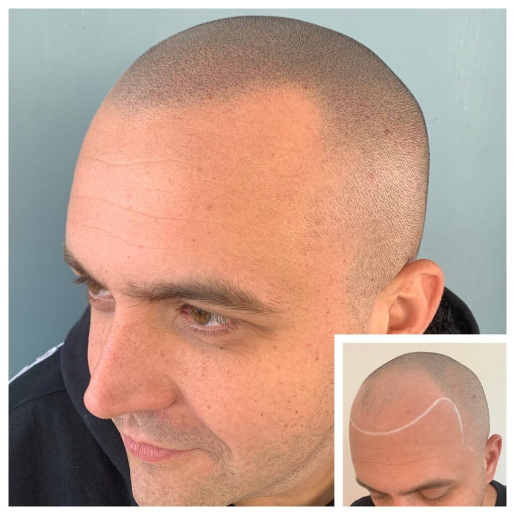 Man with a closely shaved head in side view showing even stippled density on the scalp