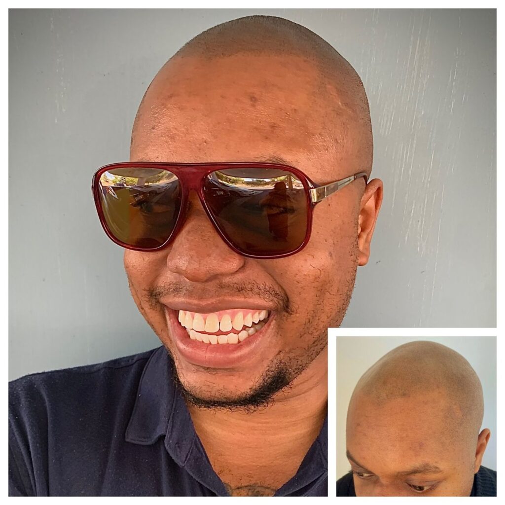 Smiling man in red sunglasses and navy polo with a closely shaved scalp, with an inset of his scalp from above.