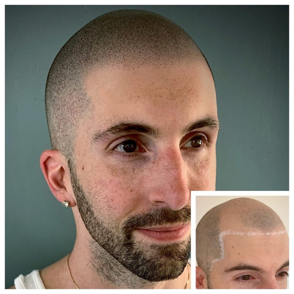 Man with a shaved head and trimmed beard in profile, with a small inset showing the hairline marked in white on the scalp.